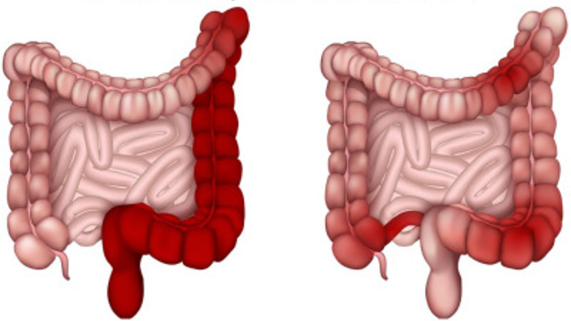 Exploring how bowel inflammation affects weight loss.